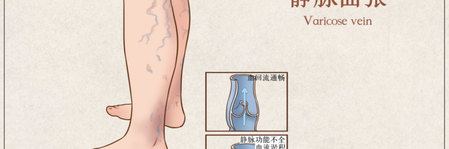 告別“蚯蚓腿”，靜脈曲張?jiān)趺凑{(diào)？