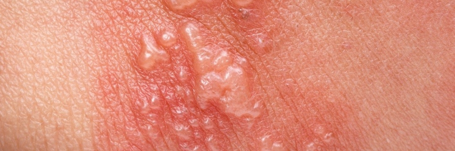 艾灸后起了小水泡，居然是邪氣在“逃跑”！