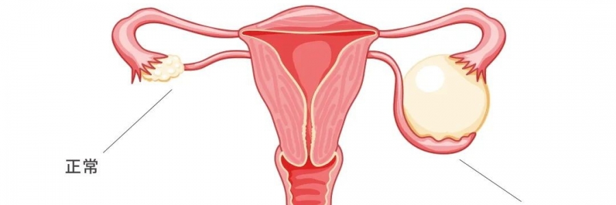 太神奇了，艾灸調(diào)好了她的卵巢囊腫！